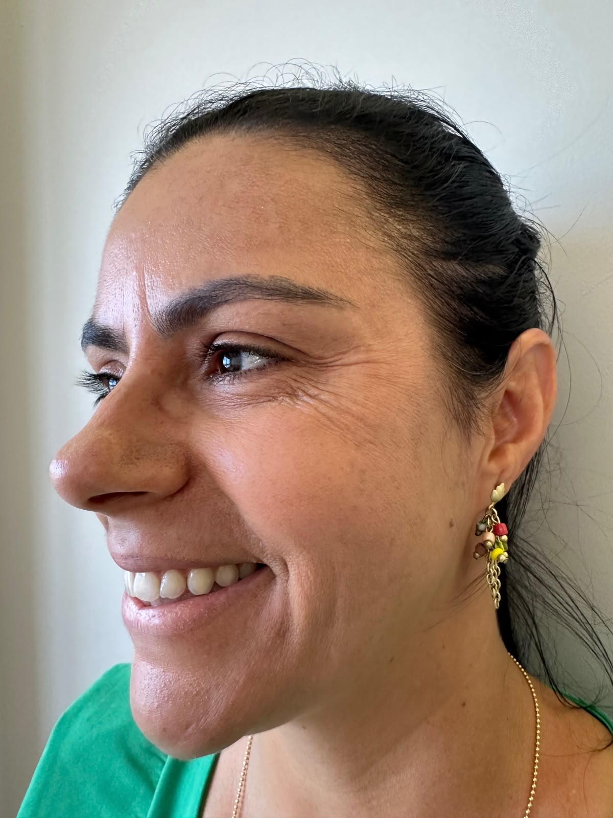 Antes — Botox