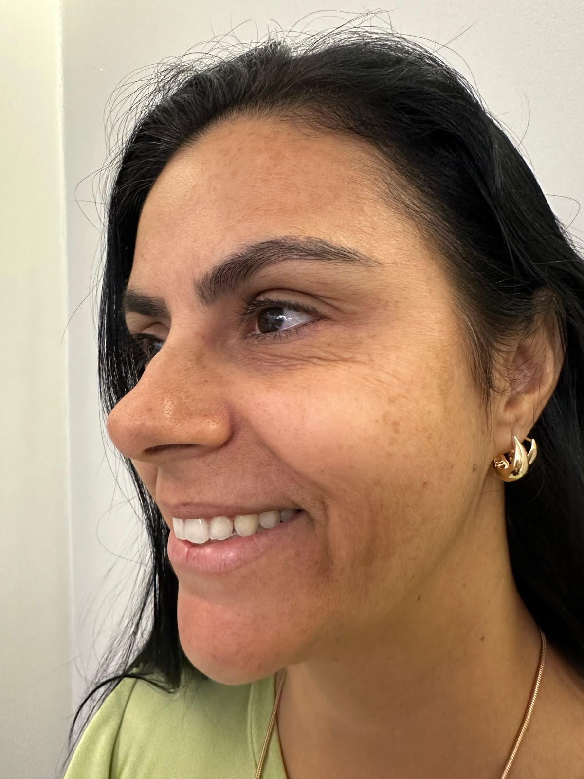 Depois — Botox