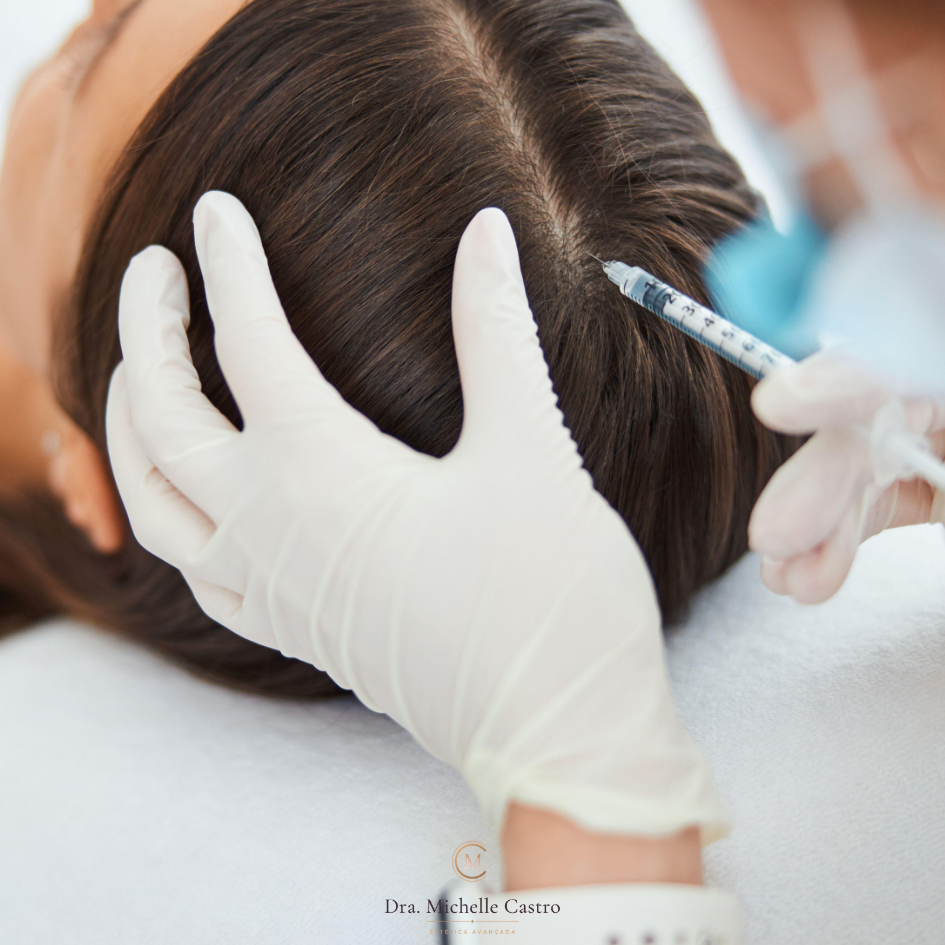 Imagem ilustrativa do tratamento Mesoterapia Capilar (Injetáveis)