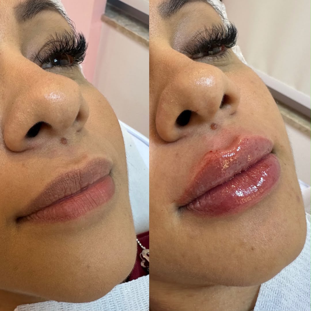 Preenchimento Labial — Injetáveis