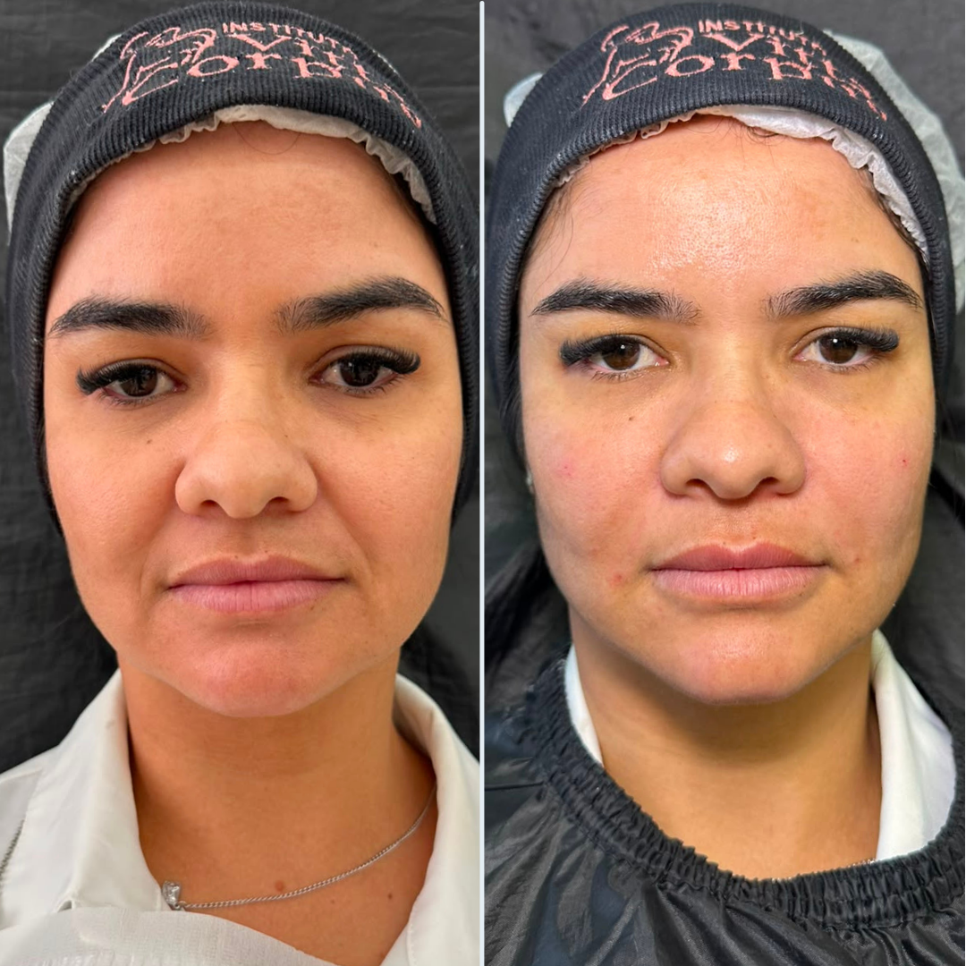 Harmonização Facial — Protocolos