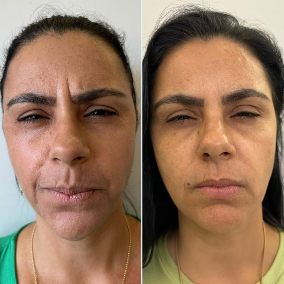 Toxina Botulínica — Injetáveis